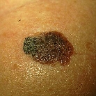 mole image mole image
