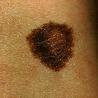 dysplastic mole image