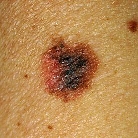 melanoma image melanoma image